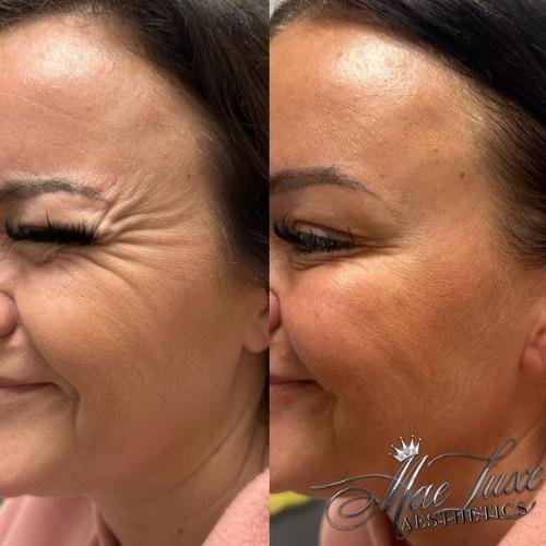 anti-wrinkle-injections