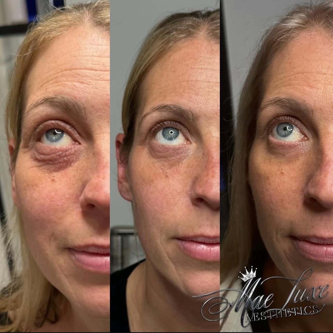 under-eye-skin-booster-newcastle